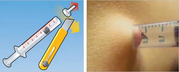 удаление клеща шприцом